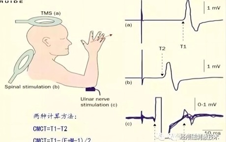 瘫痪、便秘、呼吸困难等脊髓损伤导致的后遗症，用经颅磁刺激治疗疗效显著！