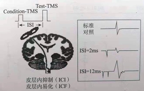 科普丨前途无量的tms新模式——单拍成对脉冲刺激（ptms）